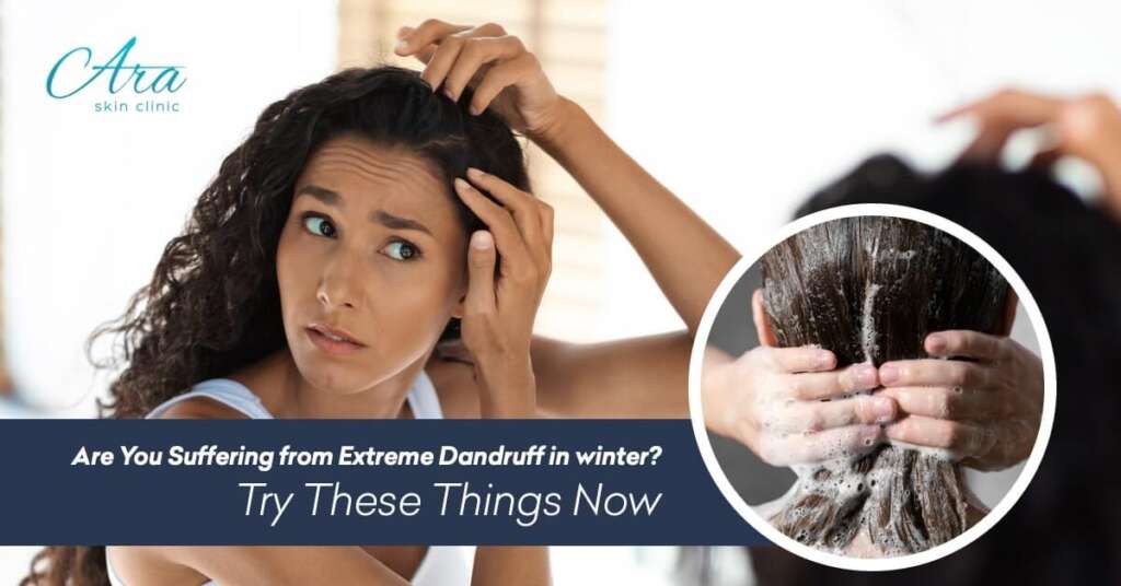 Are You suffering from Extreme Dandruff in winters