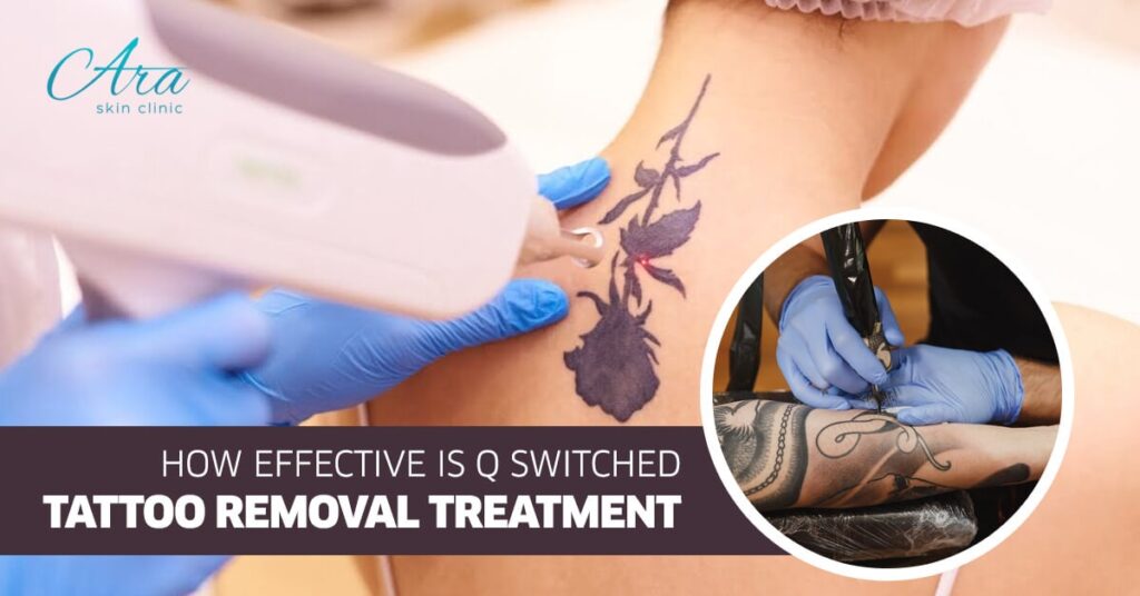 How Effective is Q Switched Tattoo Removal Treatment
