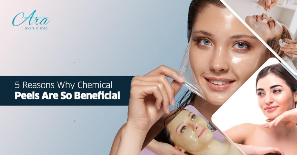 5 Reasons Why Chemical Peels Are So Beneficial
