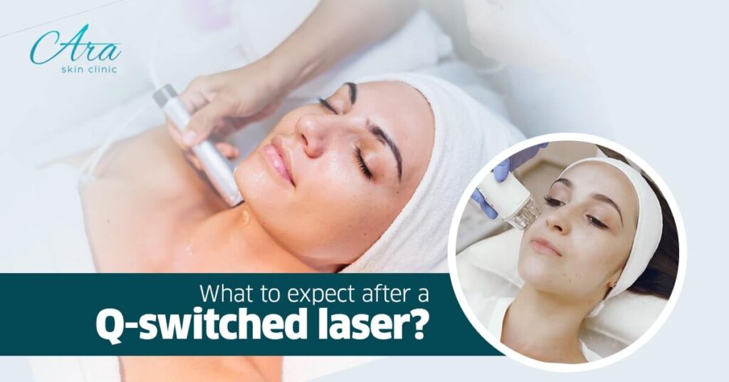 What to expect after a Q switched laser
