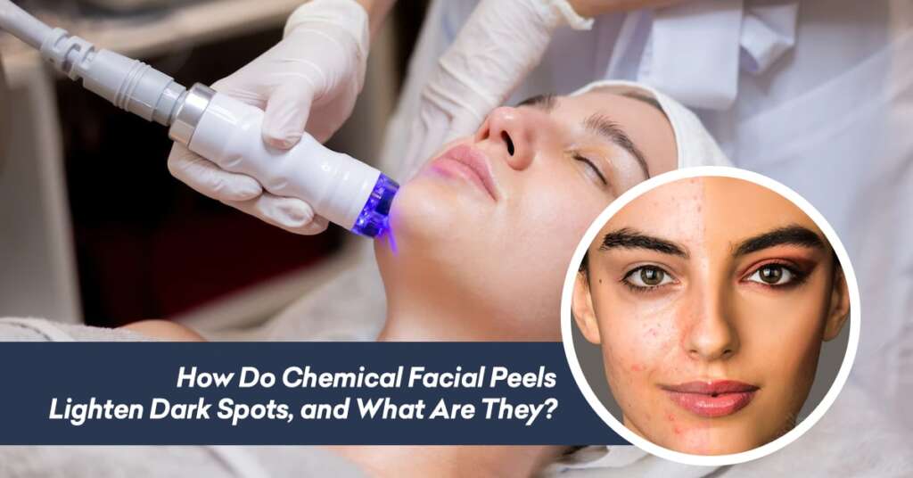 How Do Chemical Facial Peels Lighten Dark Spots, and What Are They