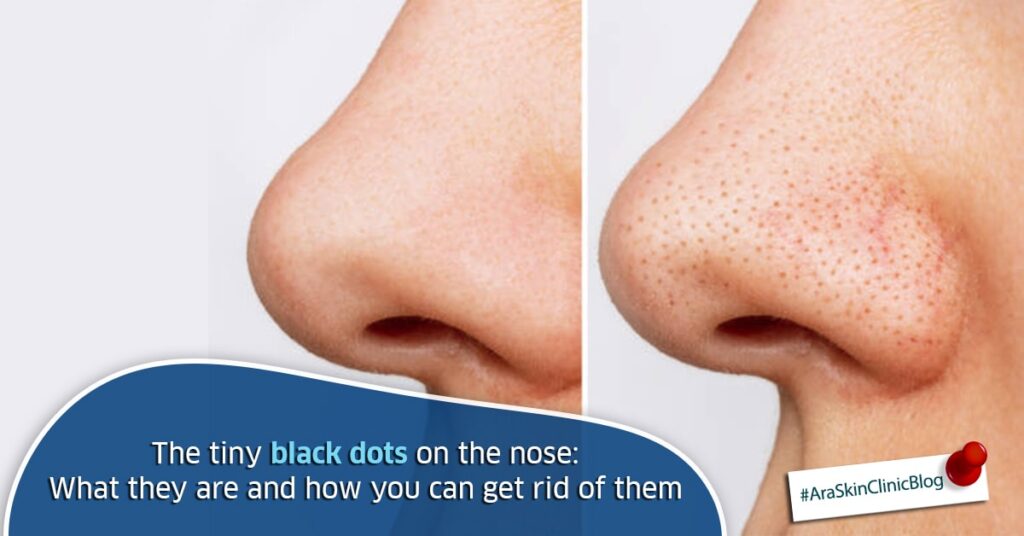 The tiny black dots on the nose What they are and how you can get rid of them